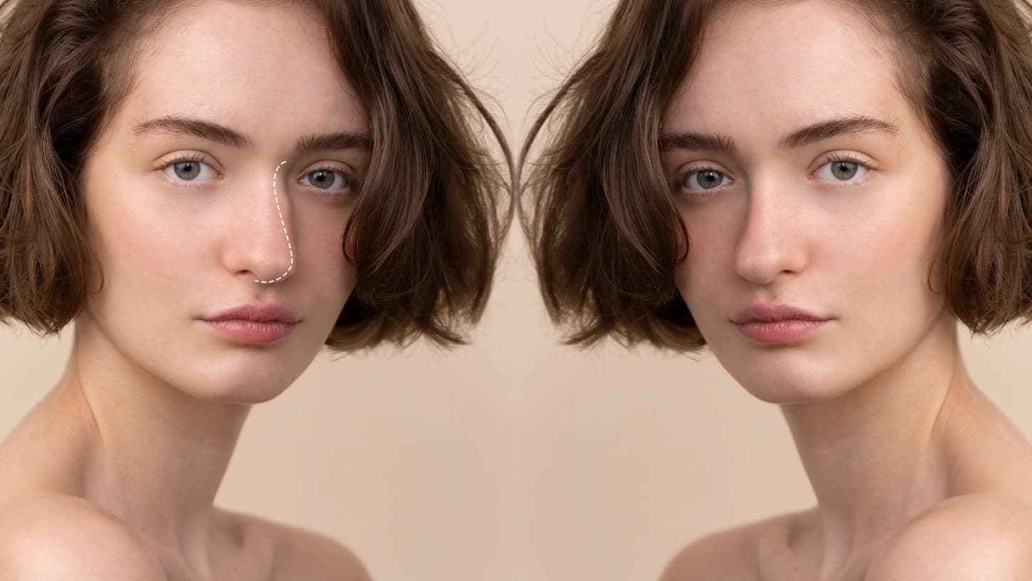 Rinoplasti Ameliyatı ile Birlikte Yapılabilecek Kombine Estetik ve Fonksiyonel İşlemler