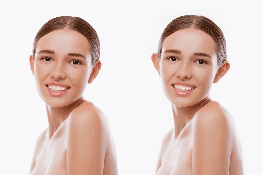 Otoplasti (Kulak Estetiği) Prominent Ear